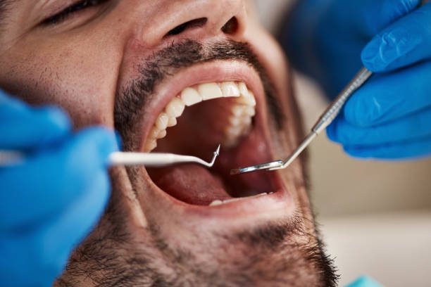 Best Emergency Dental Care for Broken or Chipped Teeth in Palm Desert, CA