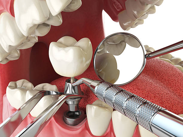 Best Emergency Tooth Extraction in Palm Desert, CA
